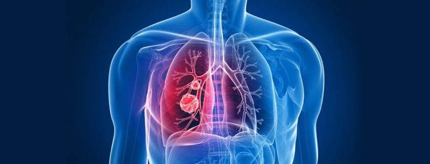 Identification of tuberculosis susceptibility gene